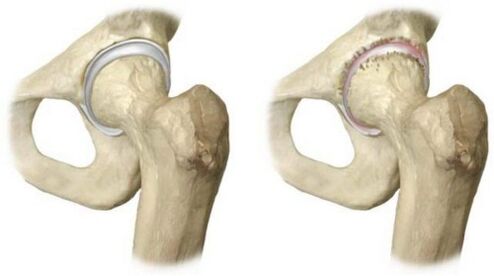 articulation de la hanche saine affectée par l'arthrose